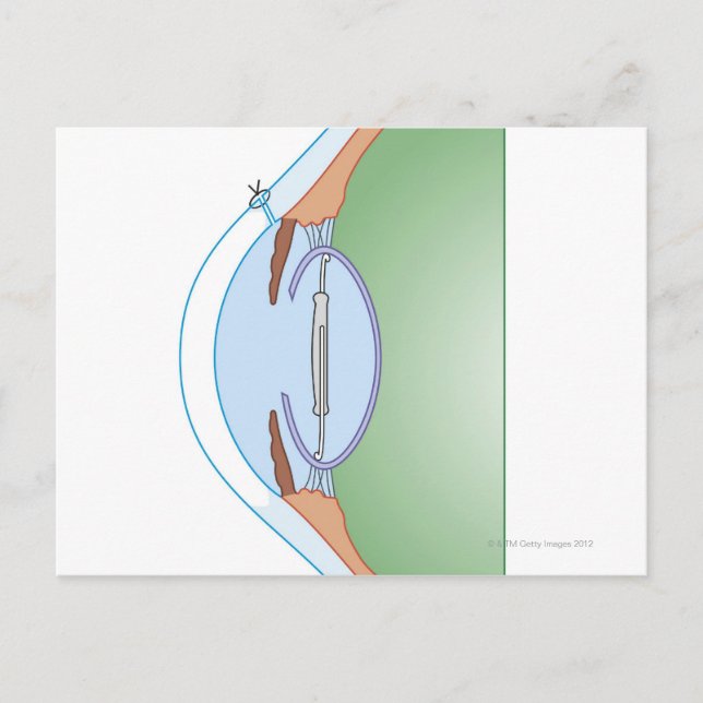Cartão Postal Cirurgia de cataratas (Frente)