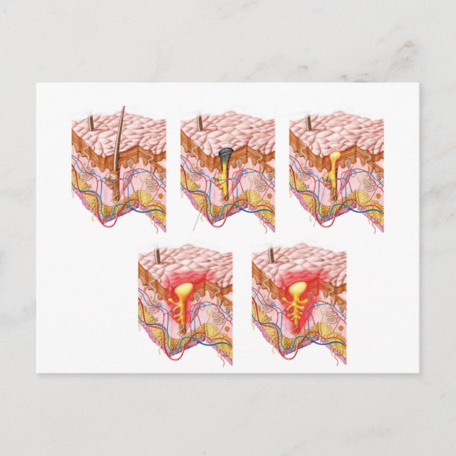 Cartão Postal Diferentes Tipos De Acne (Frente)