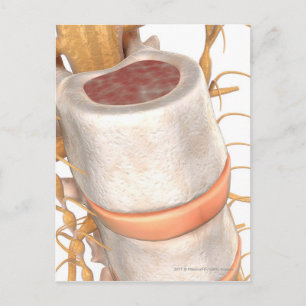 Cartão Postal Fechar um disco invertebral na coluna