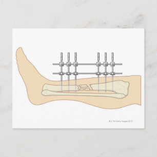 Cartão Postal Fixador externo