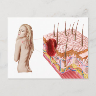 Cartão Postal Ilustração De Crescimento Atípico Na Pele