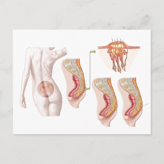 Cartão Postal Ilustração Médica De Um Cinto Pilonidal (Frente)
