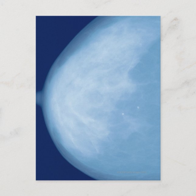 Cartão Postal Raio-X da mama feminina, vista lateral (Frente)