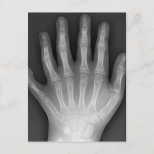 Cartão Postal Six Fingered Hand, Medical Rarity, X-Ray