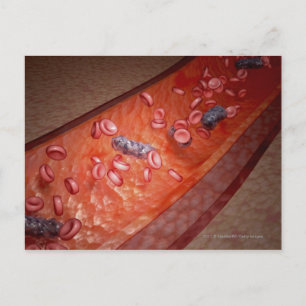 Cartão Postal Transformação microscópica de uma infecção sa