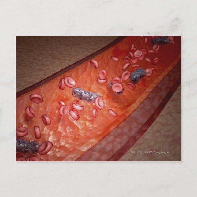 Cartão Postal Transformação microscópica de uma infecção sanguín (Frente)