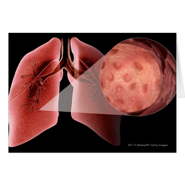 Cartão Via aérea de Inflammed durante um ataque de asma (Frente Horizontal)