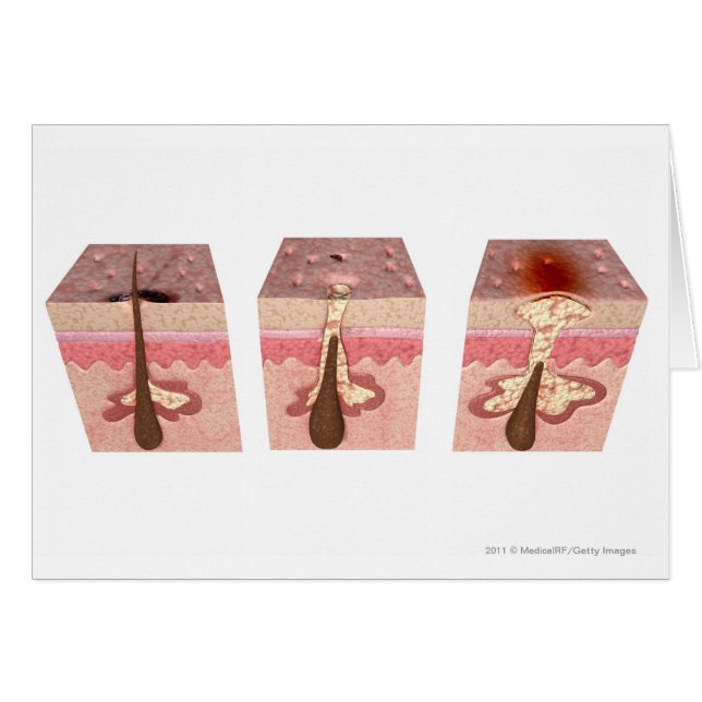 Cartão Vista das causas da acne (Frente Horizontal)