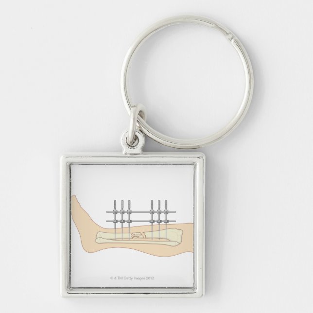 Chaveiro Fixator externo (Frente)