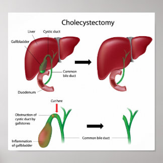 Colecistectomia remoção da vesícula biliar Poster