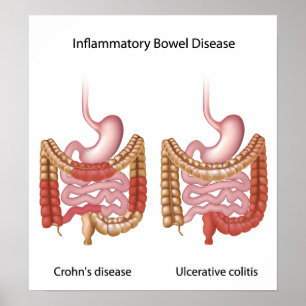 doença inflamatória intestinal (ibd) poster