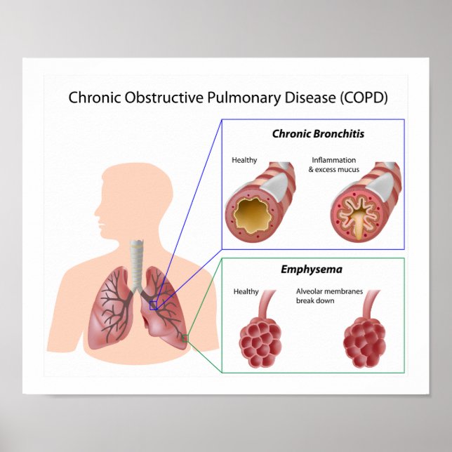 Doença pulmonar (DPOC) Poster (Frente)