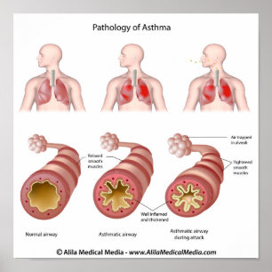 Doença pulmonar Poster de asma