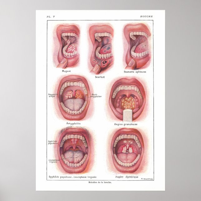Doenças da anatomia da boca Poster francês (Frente)