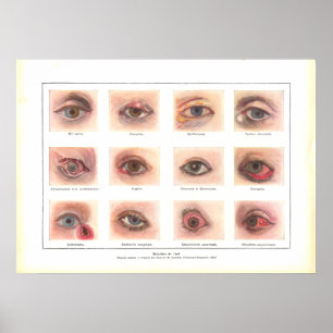 Doenças da Anatomia Ocular Poster francês