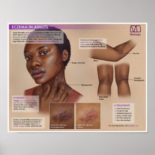 Eczema Melalógico Poster