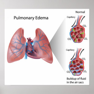 Edema pulmonar Poster