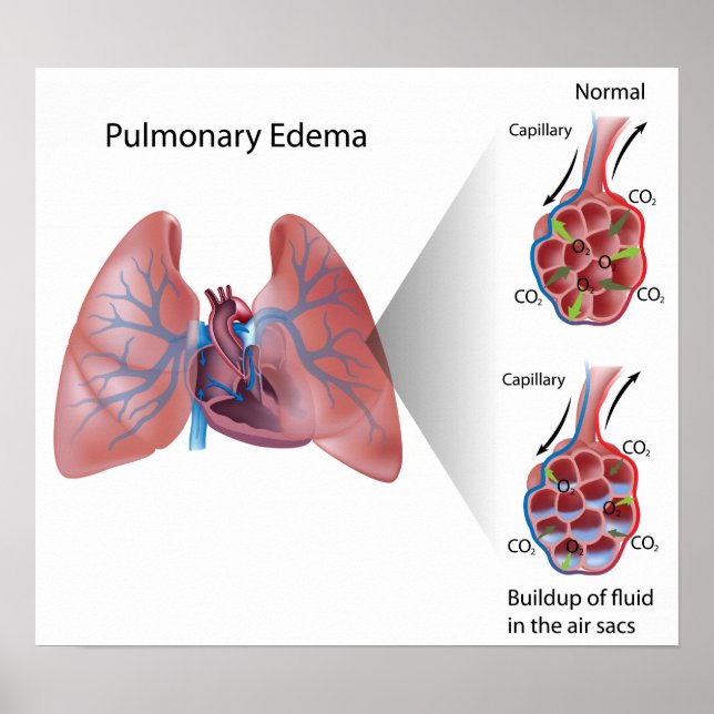 Edema pulmonar Poster (Frente)
