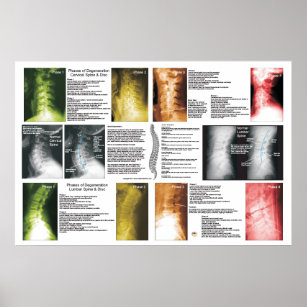 Fases Cervical Lumbar Spinal Poster