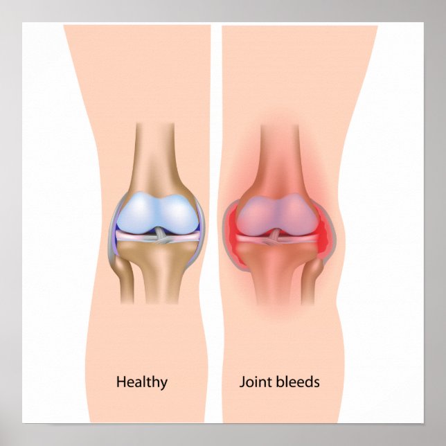 Hemorragias articulares na hemofilia Poster (Frente)