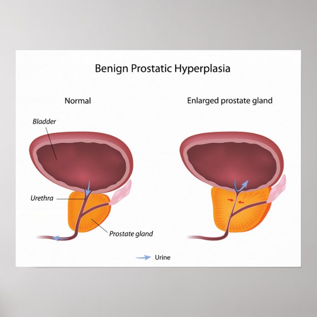 Hiperplasia prostática benigna Poster (Frente)