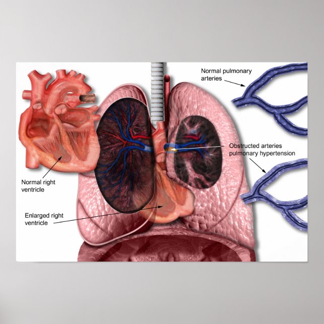 Hipertensão pulmonar poster (Frente)
