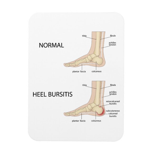 Ímã Bursitis Calcaneal (Vertical)