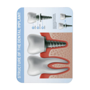 Ímã Estrutura do implante dentário