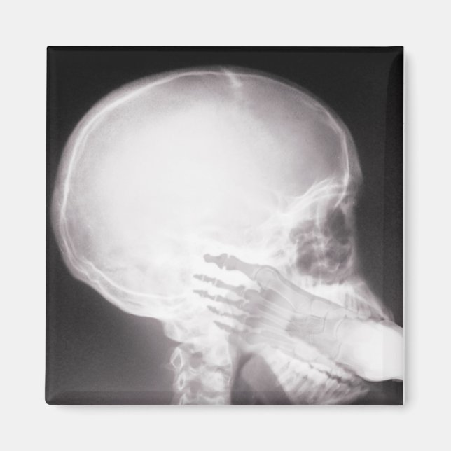 Imã Foto em raio-X da boca (Frente)