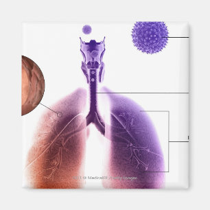 Imã Ilustração de um ataque de asma do pólen