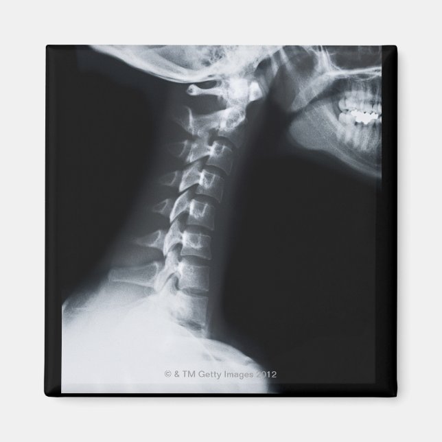 Imã raio X das vértebras do pescoço, incluindo a mandí (Frente)