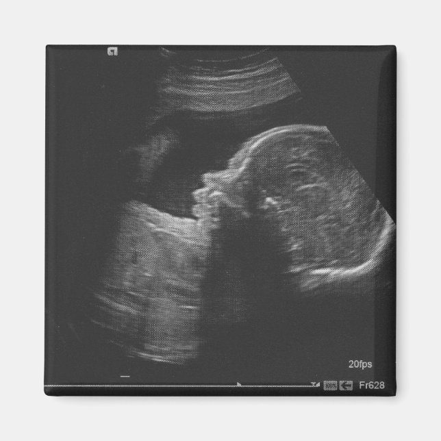 Imã Ultrassom (Frente)