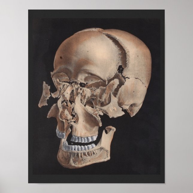 Impressão de cavidade explosiva desarticulada (Frente)