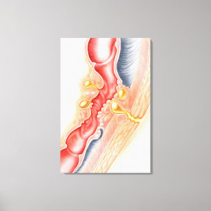 Impressão Em Tela Desenvolvimento da fístula