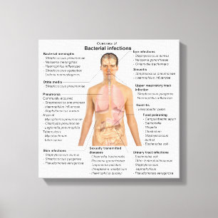 Impressão Em Tela Gráfico de infecções bacterianas em seres humanos