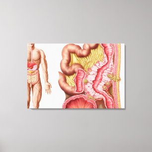 Impressão Em Tela Ilustração da diverticulose nos dois pontos