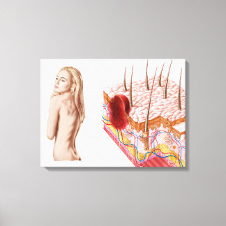 Impressão Em Tela Ilustração De Crescimento Atípico Na Pele