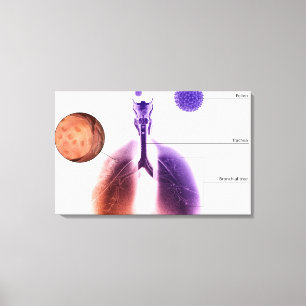 Impressão Em Tela Ilustração de um ataque de asma do pólen