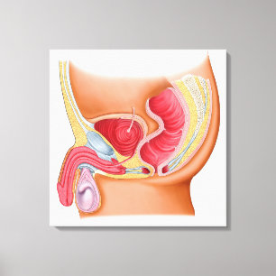 Impressão Em Tela Ilustração médica de uma fístula Rectourethral
