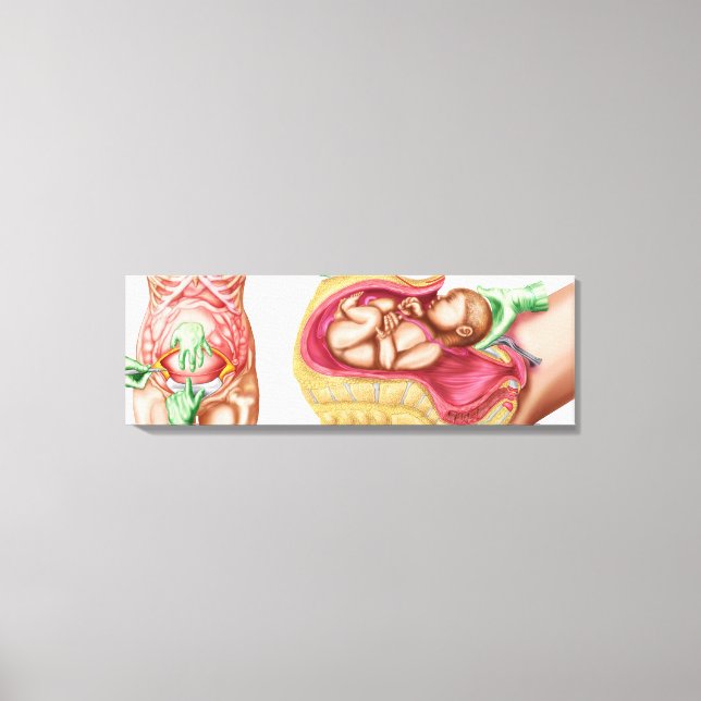 Impressão Em Tela Ilustração Mostrando Entrega Cesariana De Feto (Frente)