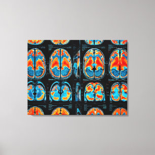 Impressão Em Tela ressonância magnética cerebral