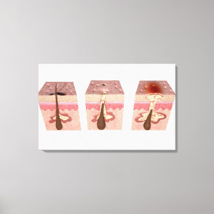 Impressão Em Tela Vista do que causa a acne