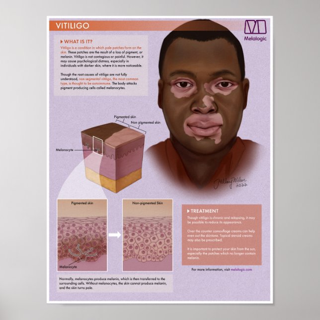 Melalogic Vitiligo Poster (Frente)