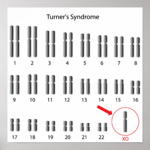 Monossomia X, Poster da síndrome de Turner