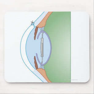 Mousepad Cirurgia da catarata