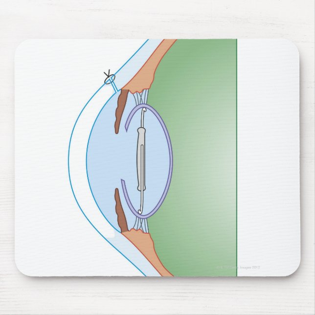 Mousepad Cirurgia de cataratas (Frente)