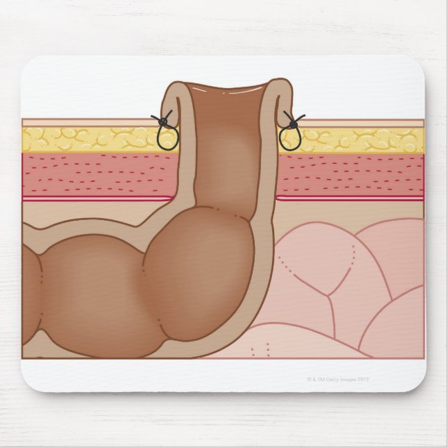 Mousepad Colostomia Permanente (Frente)
