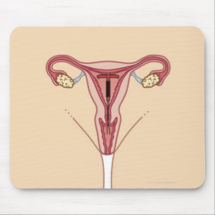 Mousepad Dispositivo intra-uterino