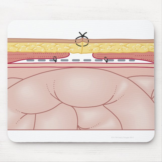 Mousepad Ilustração de uma Hérnia (Frente)