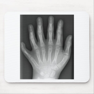 Mousepad Polydactyly, seis mãos apontado, raio X, raridade